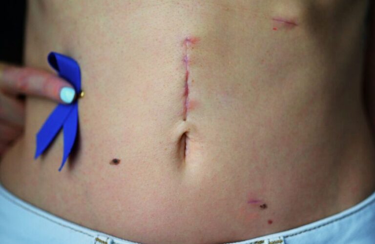 cancer colon | Jupette et Salopette